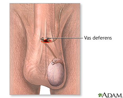 vasectomy does cum look different after Vasectomy does cum look different after